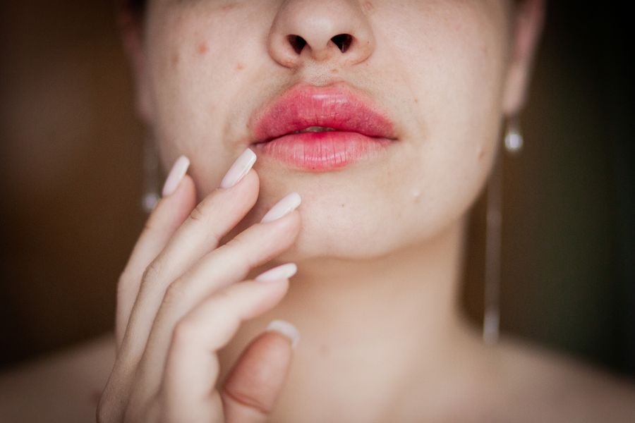 Bem-estar e naturalidade — Preenchimento com Ácido Hialurônico na Clínica Sensitivity, Osasco